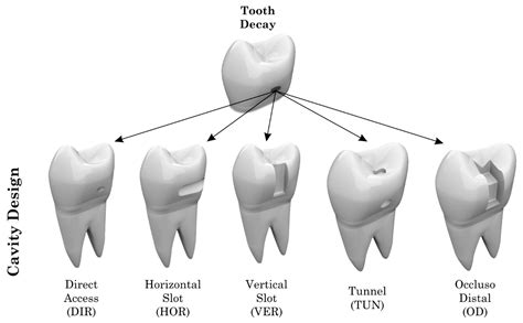 slot cavity|Class II .